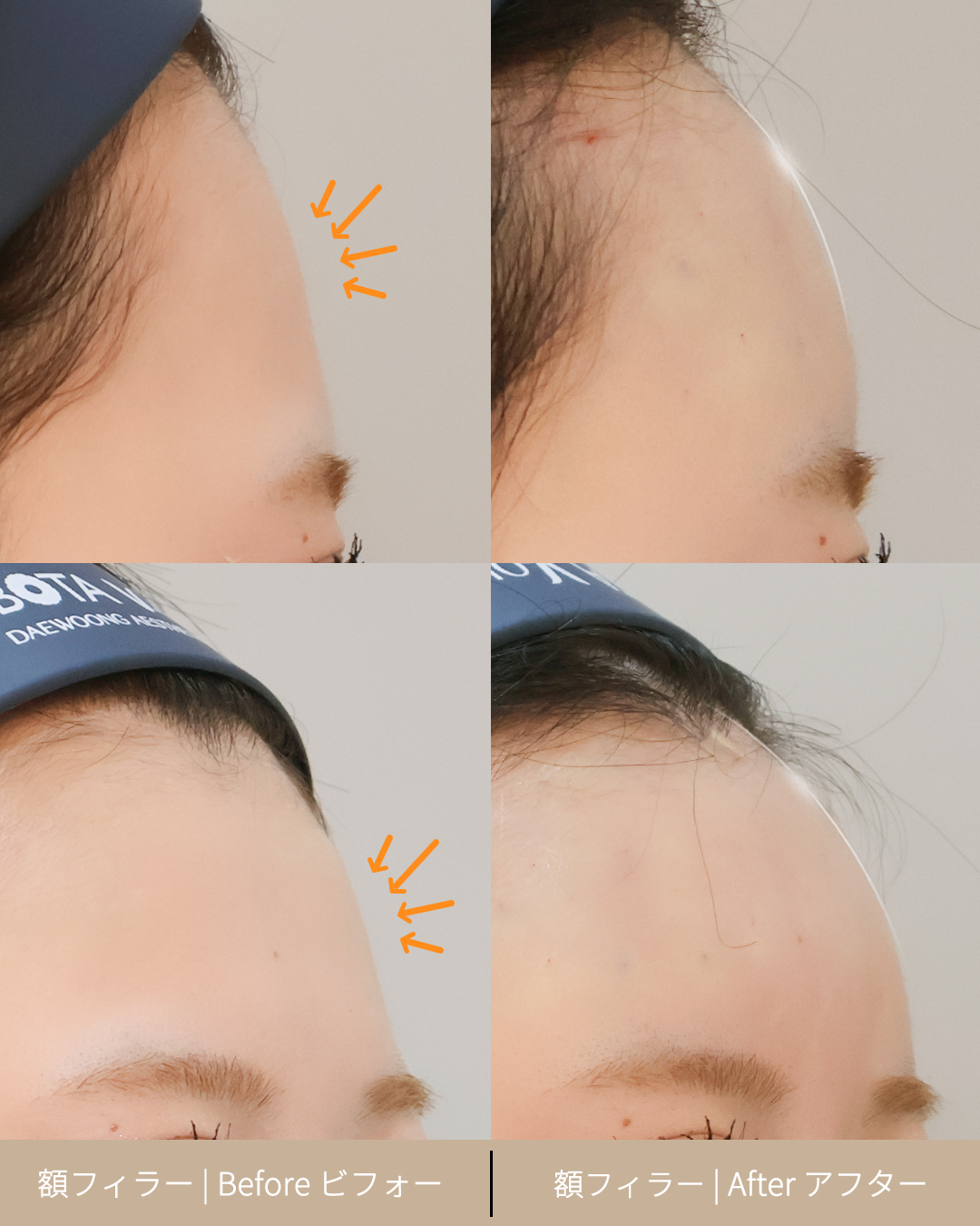 이마필러 250327 (1) J - 선 있음