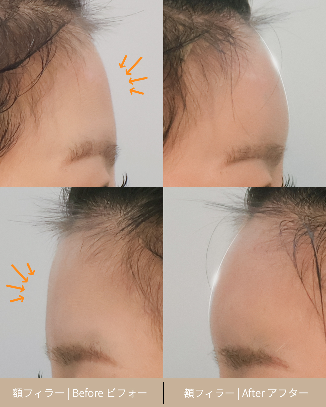 이마필러 250516 (1) J 선 있음