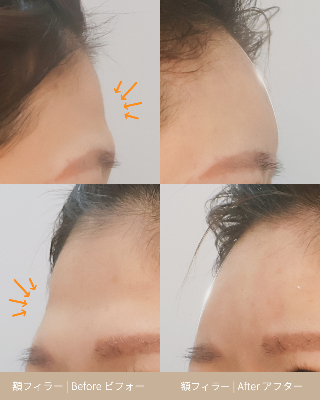 이마필러 250523 (1) J 선 있음