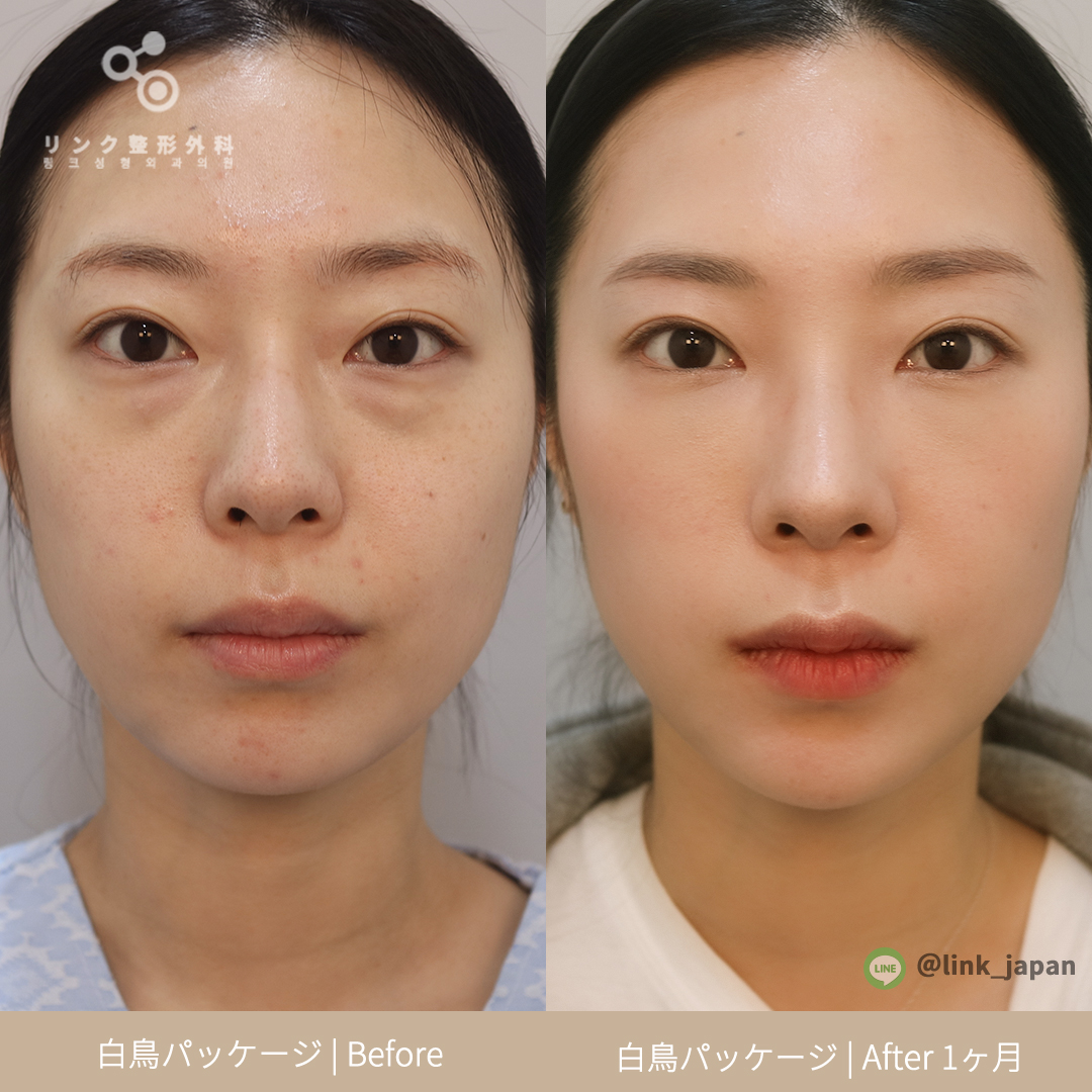 눈밑지방재배치 250724 (1) S