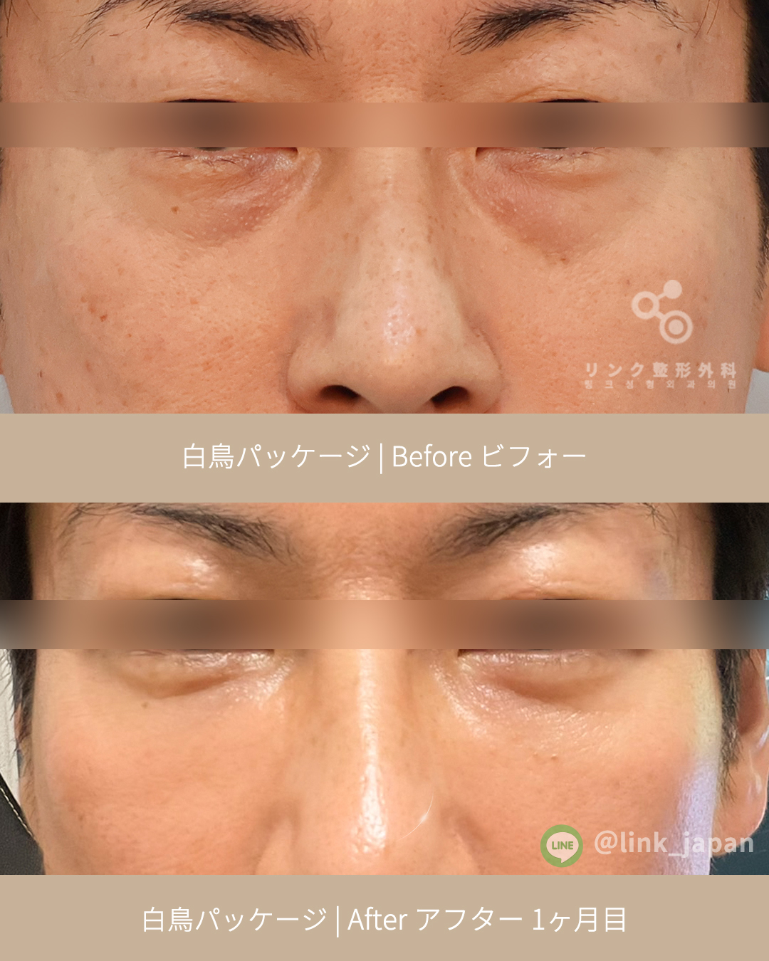 백조패키지 (눈밑지방재배치 + 아이리쥬란) 250715 (1) S - 모자이크